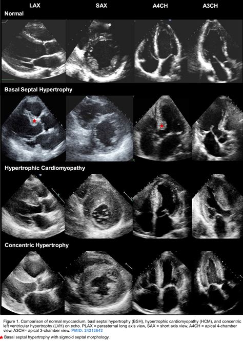 mild lv hypertrophy|lv hypertrophy on echo.